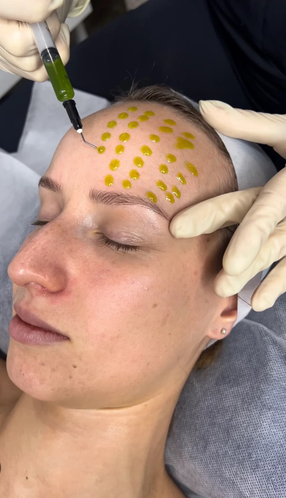 Cosmelan Depigmentation